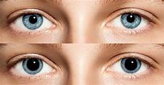 Pupillary Distance