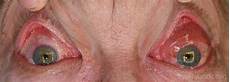 Pupillary Distance